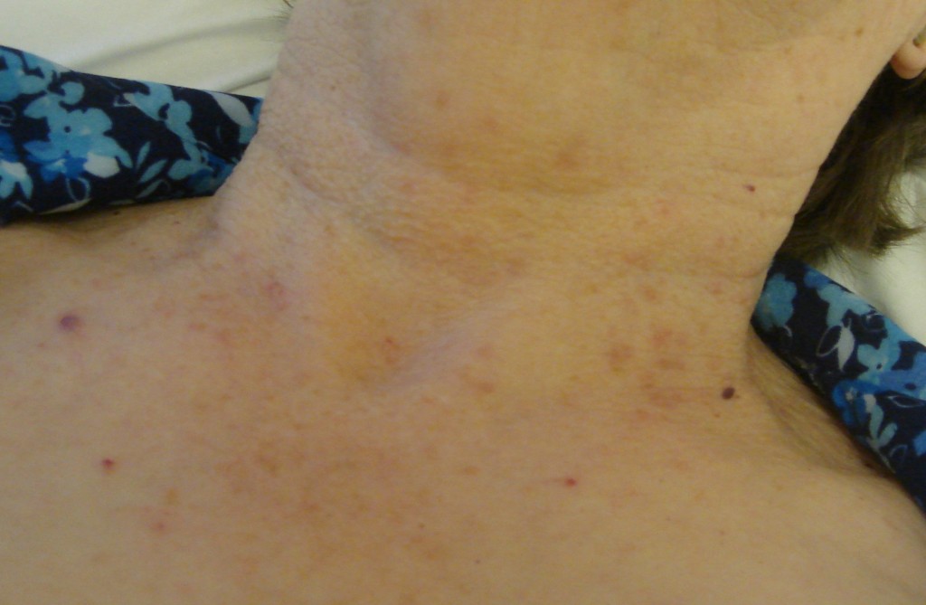 Post Advanced Electrolysis Skin Tag