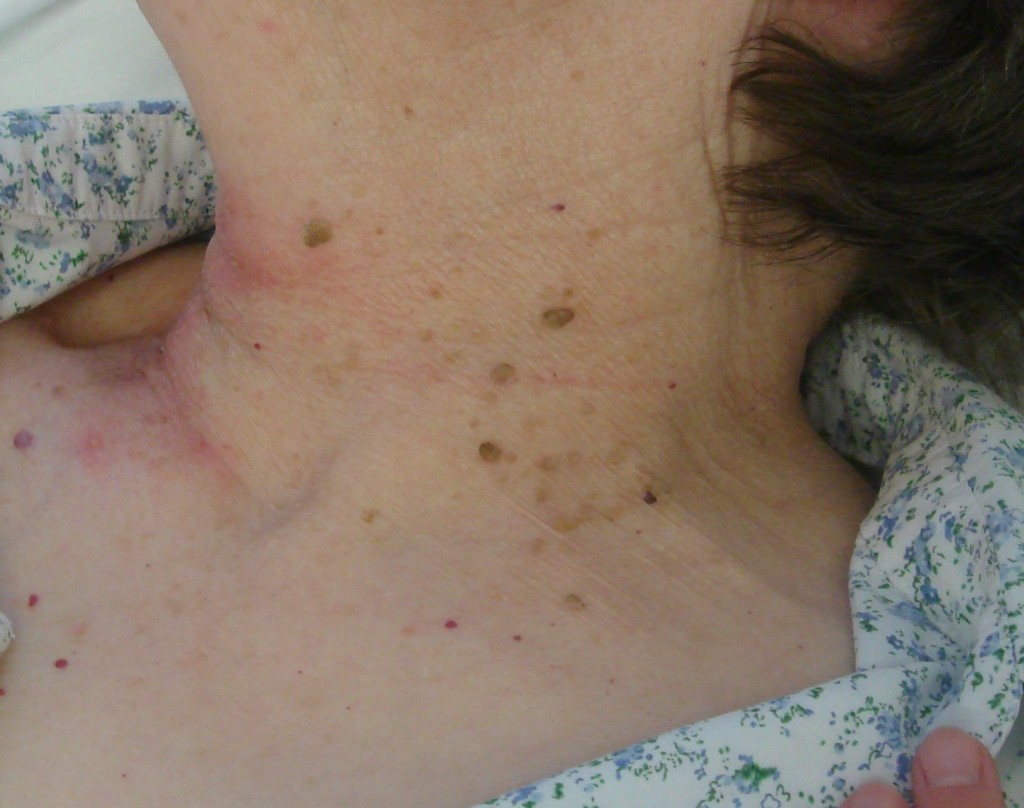 Pre Advanced Electrolysis